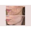 Pudderdåserne T-Zone Peeling – 50 ml.